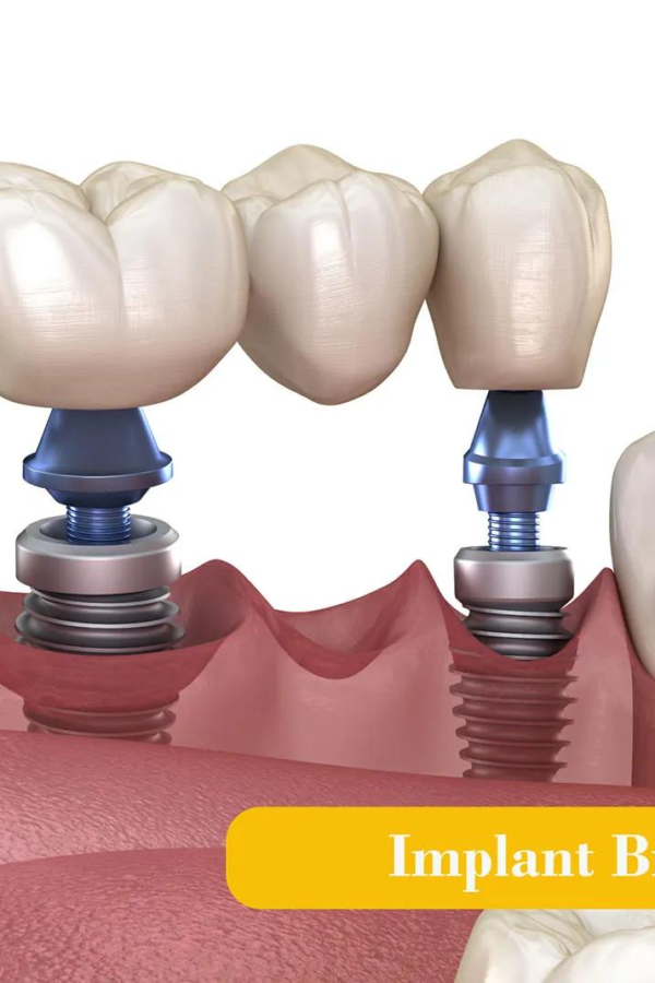Looking for a Dental Bridge in Dallas, TX? Here's What to Know