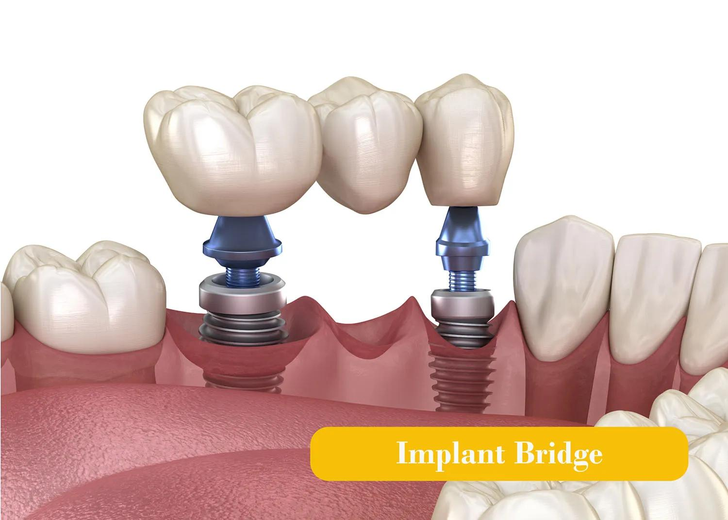 Looking for a Dental Bridge in Dallas, TX? Here's What to Know