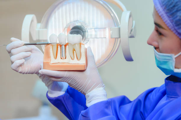 How to Find a Top Dental Implant Provider for Your Dental Needs